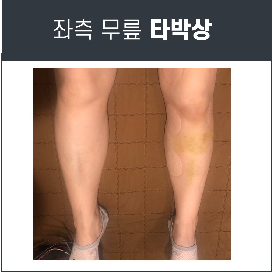 좌측 무릎 아래 정강이에 멍과 원형 자국이 있는 다리 모습 — 서울 바로한의원 초음파 약침·도침