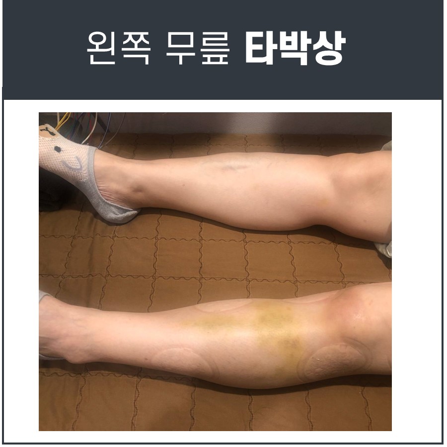[무릎 타박상, 무릎 멍] 낫지 않는다면? 초음파, MRI 검사가 필수