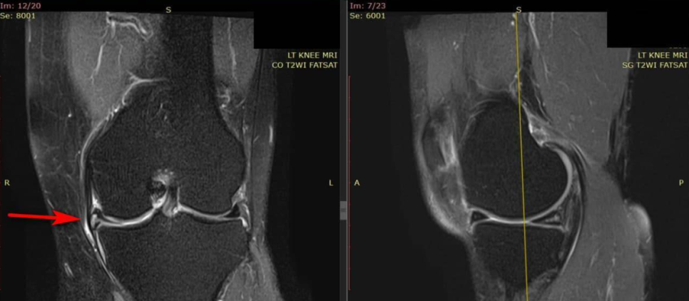 왼쪽 무릎 MRI 사진으로, 반월상 연골 부위에 빨간 화살표가 표시되어 있습니다 — 서울 바로한의원 초음파 약침·도침