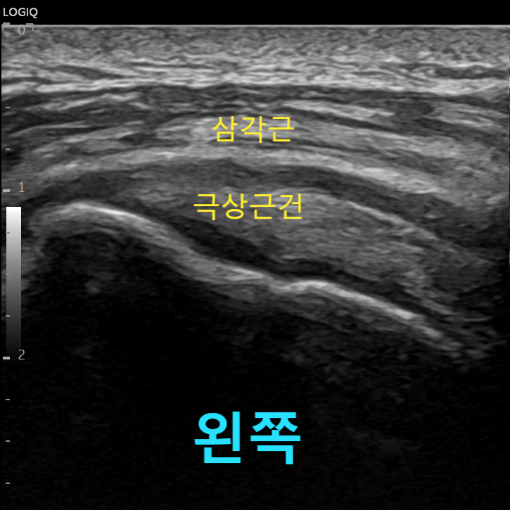 왼쪽 어깨의 삼각근과 극상근건을 나타내는 초음파 이미지 — 초음파 정밀 진단 | 서울 바로한의원 초음파 약침·도침·침도