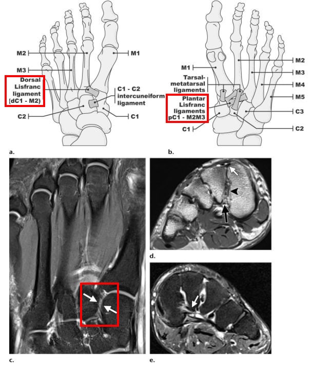 발의 리스프랑 인대 해부학적 구조를 나타내는 두 개의 도식과 세 개의 발 MRI 영상 — 서울 바로한의원 초음파 약침·도침