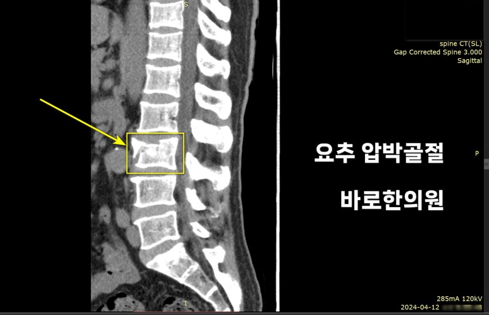 요추 CT 영상에서 압박 골절이 있는 척추뼈를 노란색 화살표와 사각형으로 표시한 모습 — 서울 바로한의원 초음파 약침·도침