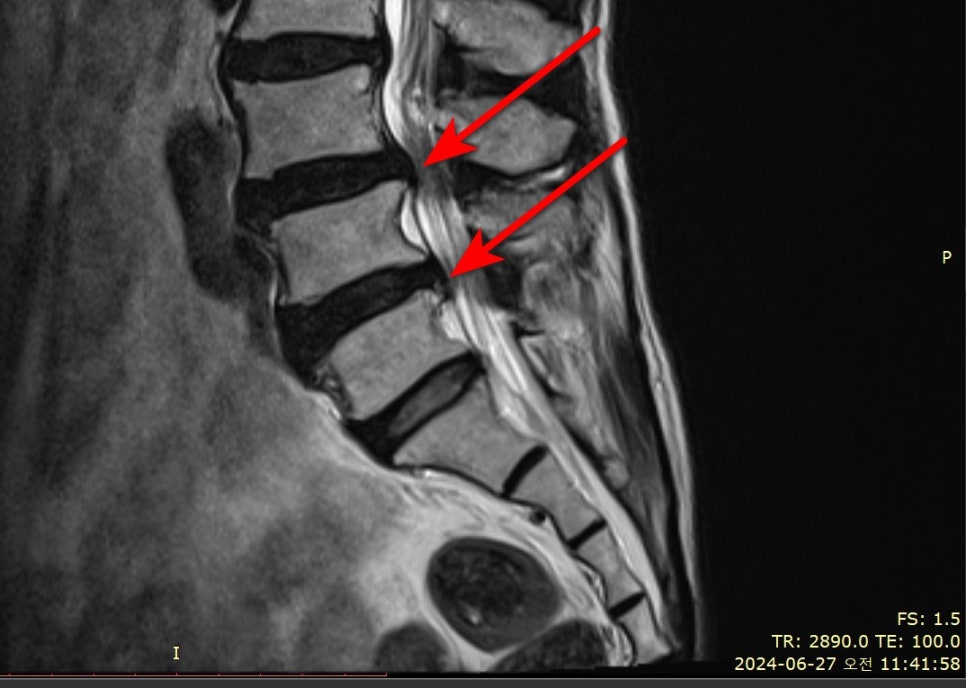 허리 MRI 사진에서 두 개의 척추 디스크가 돌출되어 있으며, 빨간색 화살표가 해당 부위를 표시하고 있다 — 서울 바로한의원 초음파 약침·도침