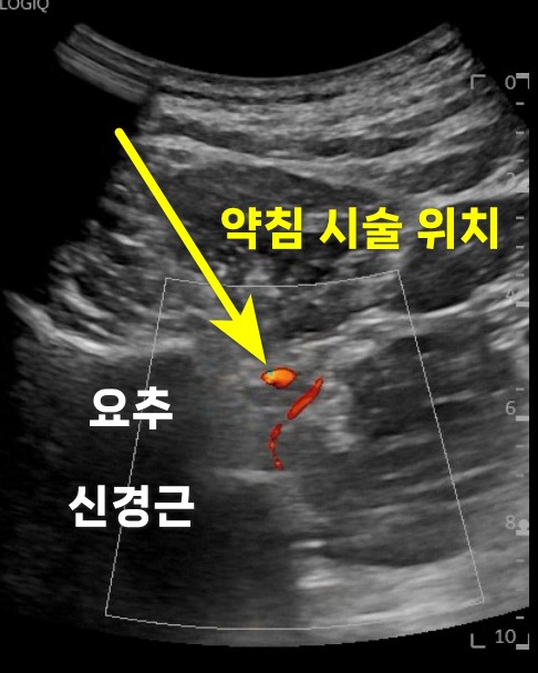 요추 신경근과 약침 시술 위치를 보여주는 초음파 이미지 — 초음파 유도하 약침 시술 | 서울 바로한의원