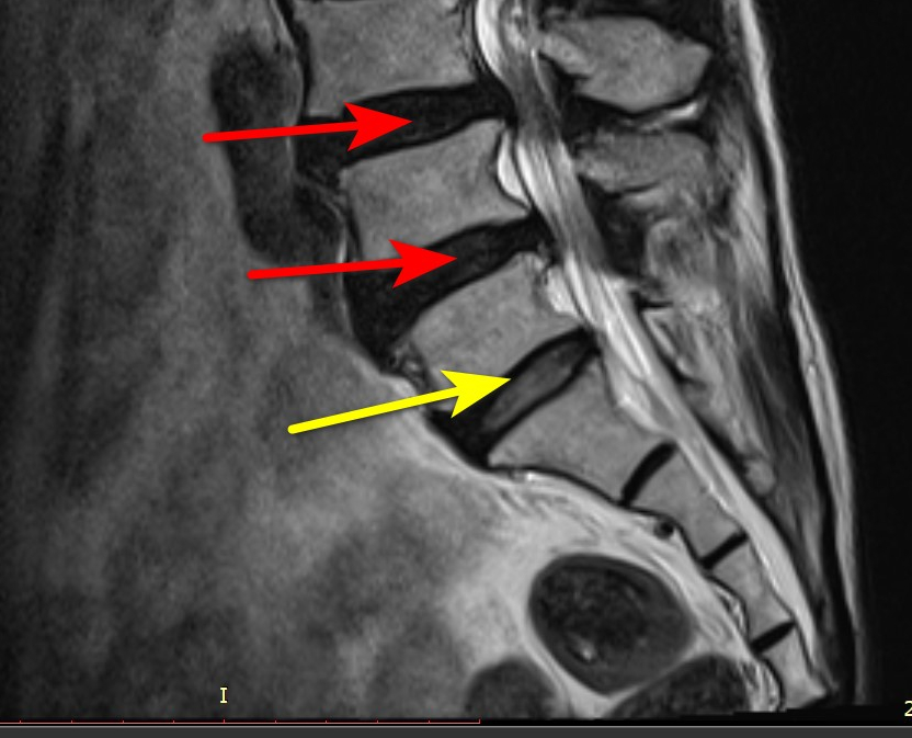 허리 MRI 사진에서 붉은색 화살표는 위쪽 두 개의 디스크 돌출을, 노란색 화살표는 아래쪽 디스크 돌출을 나타낸다 — 서울 바로한의원 초음파 약침·도침