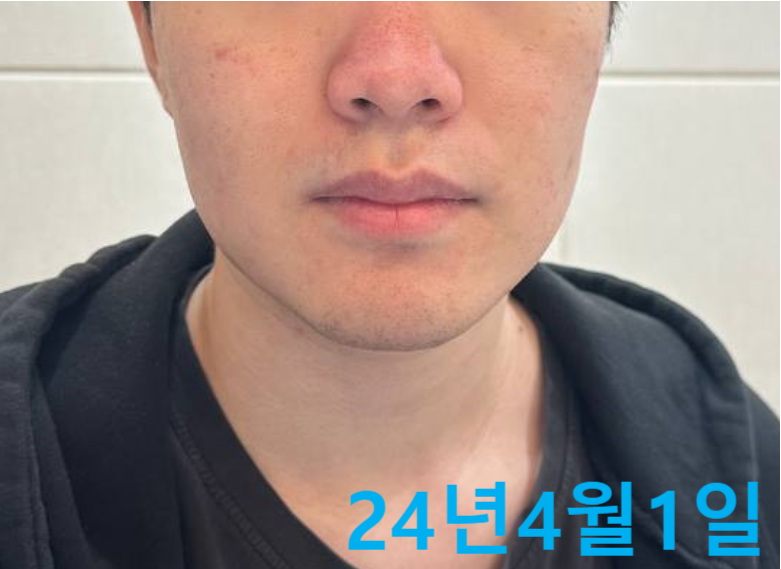 코와 볼에 붉은 기와 피부 요철이 있는 남성의 얼굴 사진. 24년 4월 1일 날짜가 표시되어 있다 — 서울 바로한의원 초음파 약침·도침