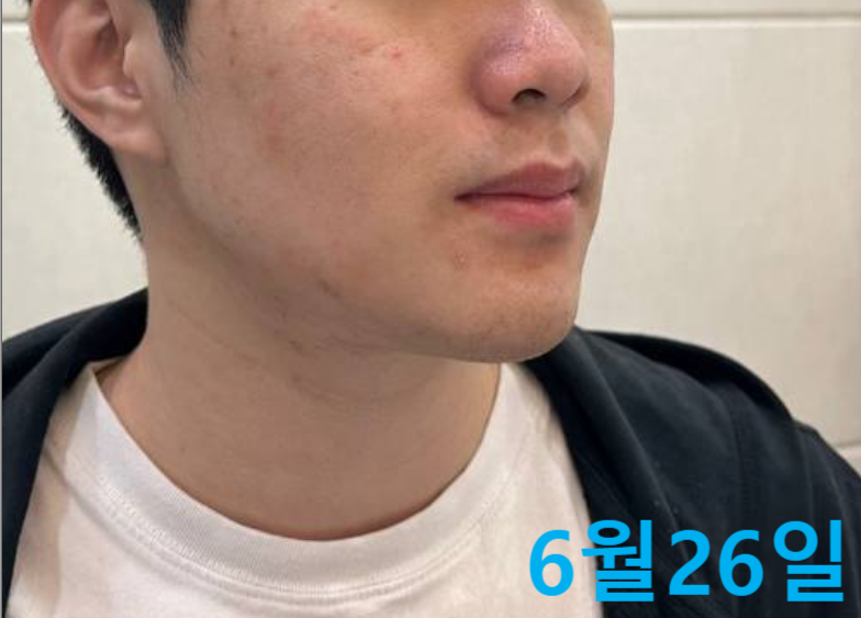 남성 얼굴의 측면으로, 뺨과 코 주변에 붉은 기와 피부 요철이 보이는 모습 — 서울 바로한의원 초음파 약침·도침