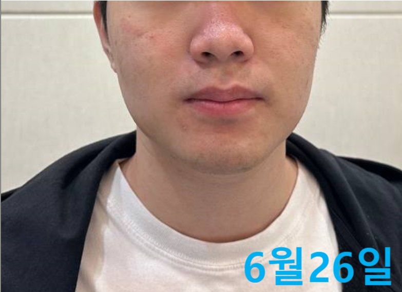 6월 26일 날짜가 표시된 남성의 얼굴과 목 부분으로, 뺨에 붉은 기와 피부 요철이 보인다 — 서울 바로한의원 초음파 약침·도침