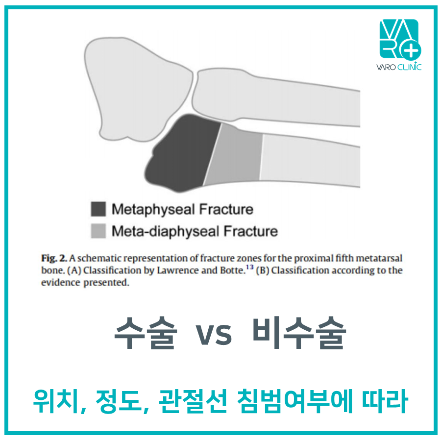 발등 뼈 골절 부위를 나타내는 도식으로, 골절 유형과 수술 여부 결정 기준에 대한 한국어 문구가 함께 표시되어 있습니다 — 서울 바로한의원 초음파 약침·도침
