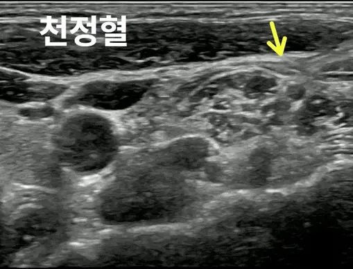 목 부위의 초음파 사진으로, 천정혈 부근의 조직과 노란색 화살표가 보인다 — 초음파 정밀 진단 | 서울 바로한의원 초음파 약침·도침·침도