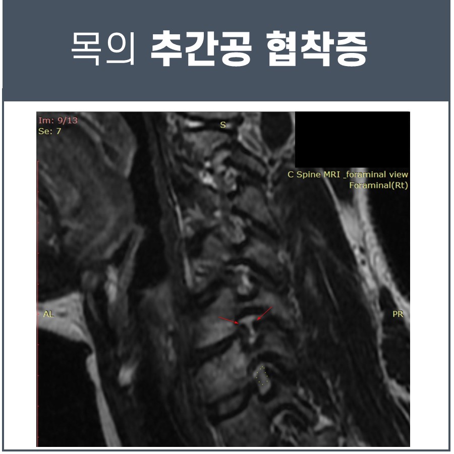 목 MRI 영상에서 추간공 협착증으로 좁아진 부위를 화살표로 표시한 모습 — 서울 바로한의원 초음파 약침·도침