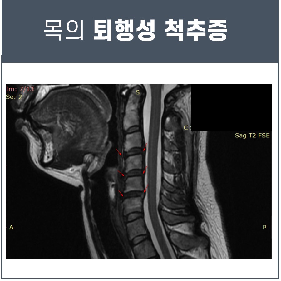 빨간 화살표로 퇴행성 변화가 표시된 목 부위의 MRI 영상 — 서울 바로한의원 초음파 약침·도침