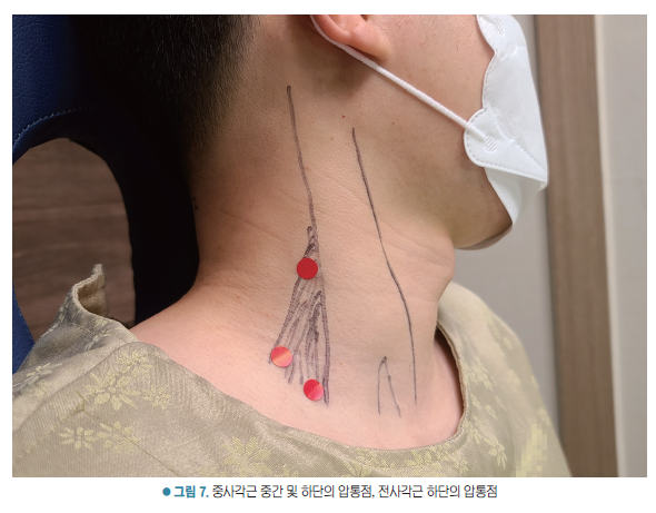 마스크를 착용한 사람의 목에 중사각근과 전사각근의 압통점을 표시한 모습 — 서울 바로한의원 초음파 약침·도침
