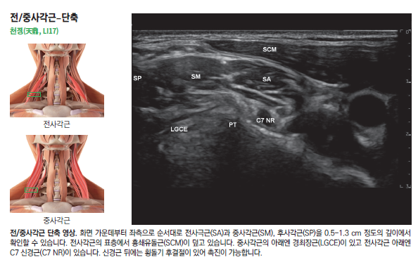 목 앞쪽과 중간 사각근의 해부학적 그림과 초음파 영상. 초음파 영상에는 사각근과 C7 신경근이 보인다 — 초음파 정밀 진단 | 서울 바로한의원 초음파 약침·도침·침도