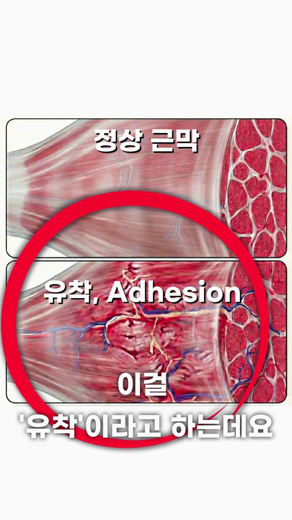 정상 근막과 유착된 근막의 모습을 비교하는 그림 — 서울 바로한의원 초음파 약침·도침