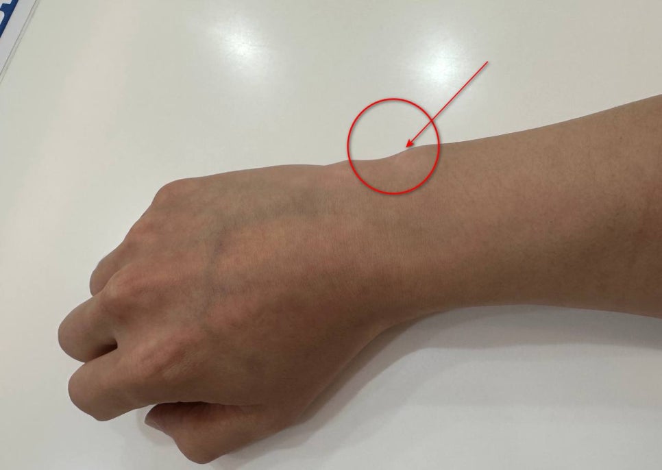 손목 바깥쪽 특정 부위를 빨간색 원과 화살표로 표시한 손과 팔뚝 사진 — 서울 바로한의원 초음파 약침·도침