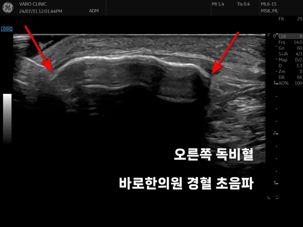 슬개골이 골절된 초음파 사진 — 초음파 정밀 진단 | 서울 바로한의원 초음파 약침·도침·침도