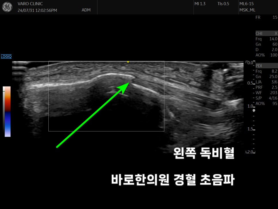 무릎 슬개건 부위를 초음파로 촬영한 사진이며, 녹색 화살표가 슬개건을 가리키고 있다 — 초음파 정밀 진단 | 서울 바로한의원 초음파 약침·도침·침도