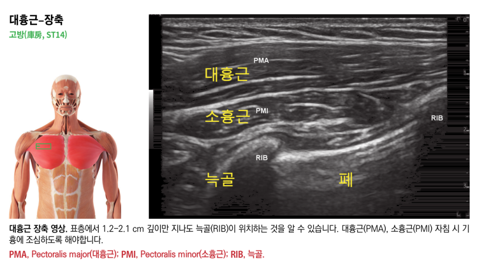 대흉근과 소흉근의 해부학적 위치를 보여주는 인체 모형과 대흉근, 소흉근, 늑골, 폐가 표시된 가슴 부위 초음파 영상 — 초음파 정밀 진단 | 서울 바로한의원 초음파 약침·도침·침도