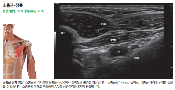 소흉근 해부학적 그림과 소흉근, 액와동맥, 상완신경총이 보이는 초음파 영상 — 초음파 정밀 진단 | 서울 바로한의원 초음파 약침·도침·침도