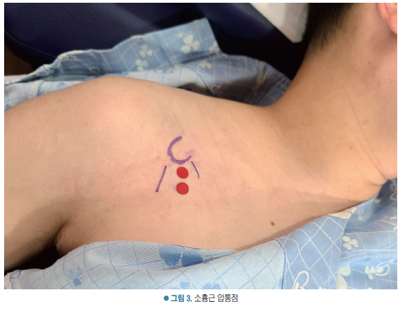 환자의 어깨와 가슴 부위에 소흉근 압통점을 표시한 모습 — 서울 바로한의원 초음파 약침·도침