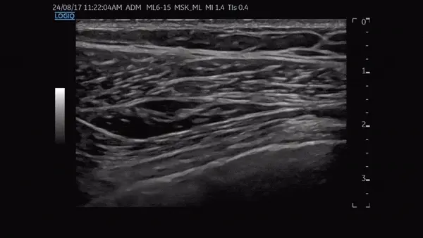 가슴 근육의 초음파 영상 — 초음파 정밀 진단 | 서울 바로한의원 초음파 약침·도침·침도