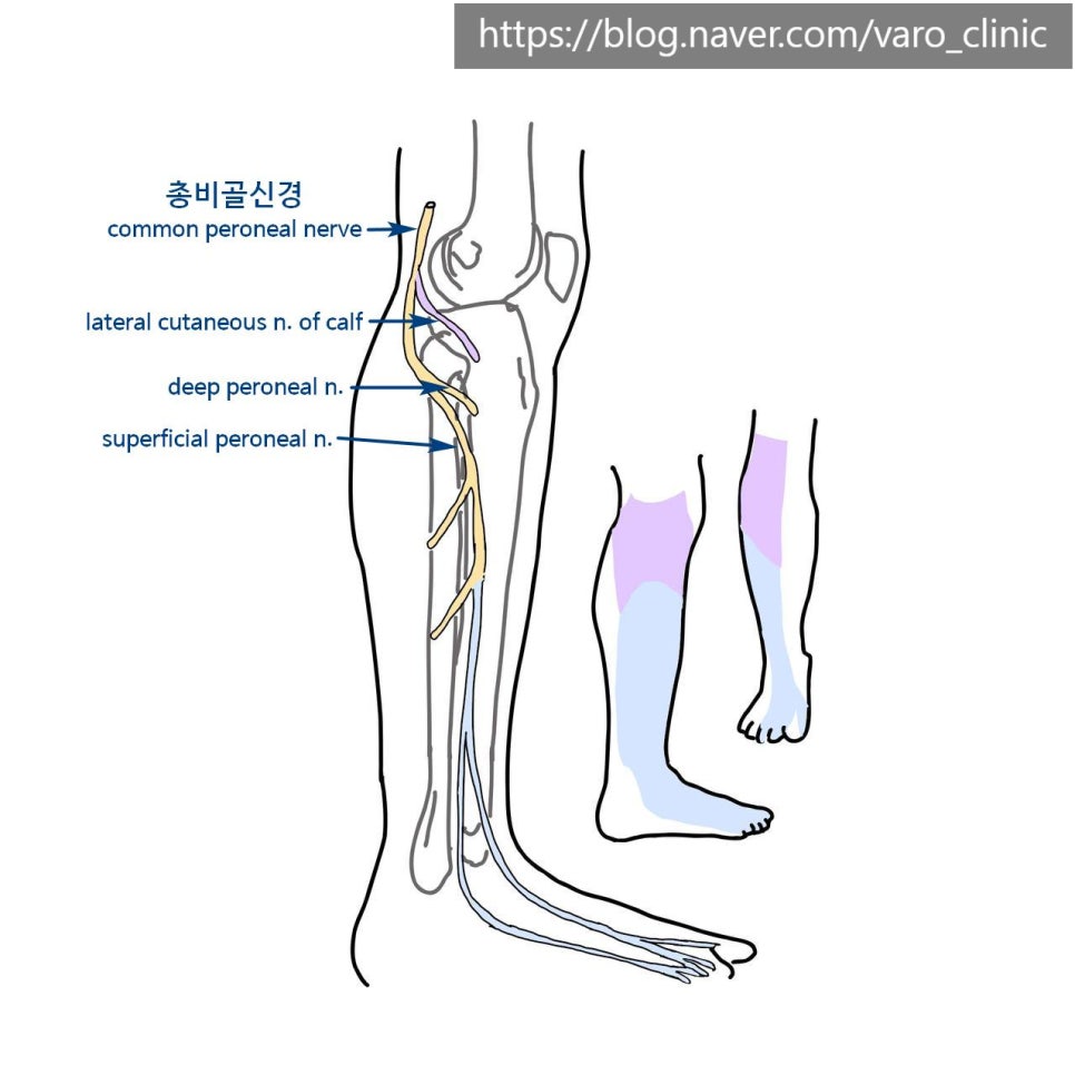 다리 비골신경과 그 가지들의 해부학적 구조 및 감각 지배 영역을 보여주는 그림 — 서울 바로한의원 초음파 약침·도침