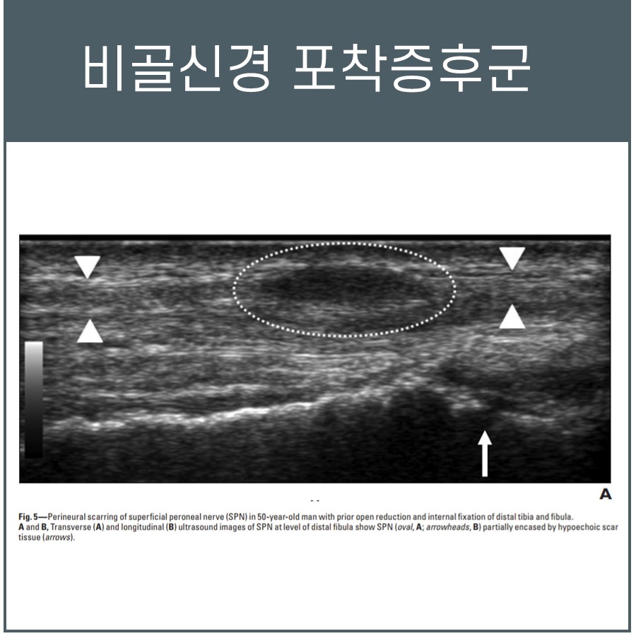 비골신경 포착증후군 초음파 사진으로, 비골신경과 흉터 조직이 나타나 있습니다 — 초음파 정밀 진단 | 서울 바로한의원 초음파 약침·도침·침도