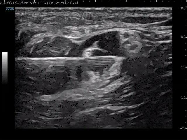 초음파 영상에서 약침 시술을 위해 조직에 삽입된 침 — 초음파 유도하 약침 시술 | 서울 바로한의원