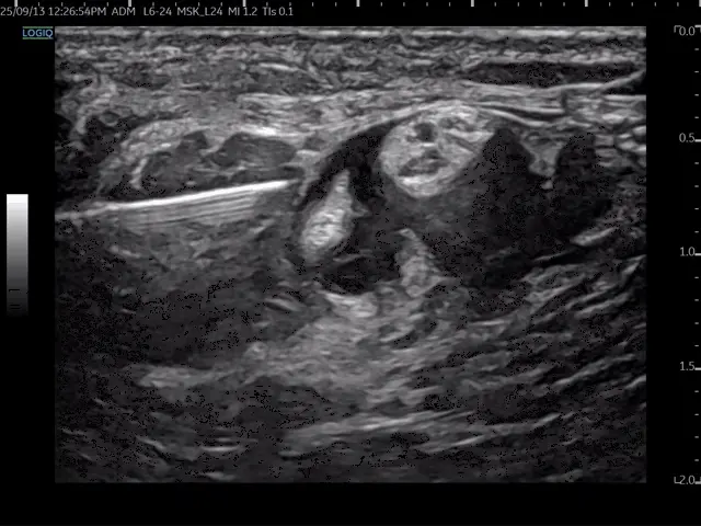 초음파로 비골신경 주변에 주사 바늘이 삽입된 모습 — 초음파 유도하 약침 시술 | 서울 바로한의원