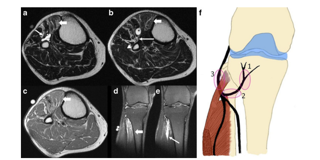 다리 MRI 영상 5개와 비골신경의 해부학적 위치를 나타내는 그림 — 서울 바로한의원 초음파 약침·도침