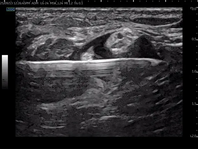 초음파 화면에 조직과 삽입된 침이 보이는 모습 — 초음파 정밀 진단 | 서울 바로한의원 초음파 약침·도침·침도