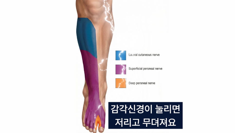 사람 다리와 발의 측면 피부 신경, 얕은 비골 신경, 깊은 비골 신경의 감각 분포 영역을 색깔로 표시한 그림. 감각 신경이 눌리면 저리고 무뎌진다는 한국어 문구가 함께 있습니다 — 서울 바로한의원 초음파 약침·도침
