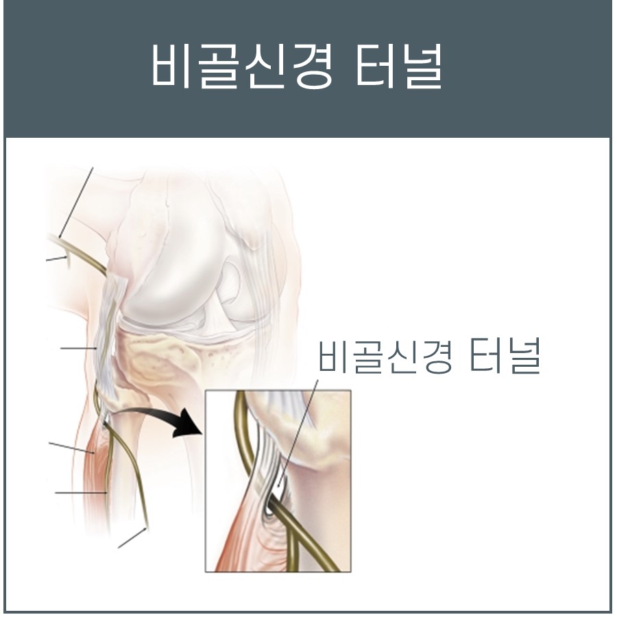 비골신경과 비골신경 터널의 해부학적 구조를 보여주는 그림 — 서울 바로한의원 초음파 약침·도침
