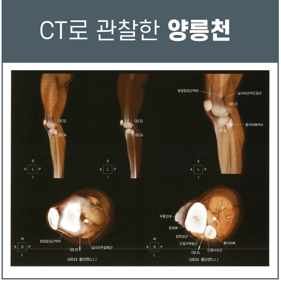 무릎과 종아리 부위의 CT 영상으로 양릉천(GB34) 혈자리를 표시한 모습 — 서울 바로한의원 초음파 약침·도침