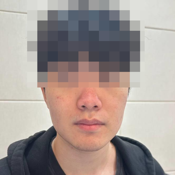 얼굴의 코와 볼 주변이 붉고 붉은 반점이 있는 사람의 모습 — 서울 바로한의원 초음파 약침·도침