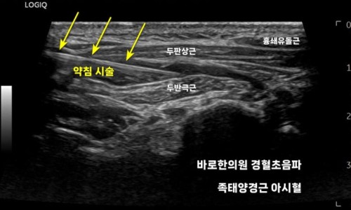 목 부위 근육에 약침 시술이 진행되는 초음파 영상 — 초음파 유도하 약침 시술 | 서울 바로한의원
