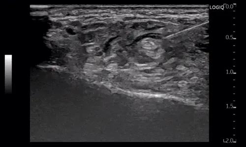 초음파 이미지에서 조직 내에 삽입된 주사 바늘이 보인다 — 초음파 유도하 약침 시술 | 서울 바로한의원