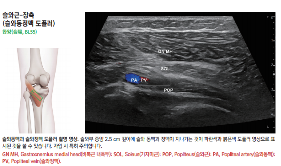 무릎 뒤쪽 슬와근의 해부학적 위치와 슬와 동정맥의 도플러 초음파 영상 — 초음파 정밀 진단 | 서울 바로한의원 초음파 약침·도침·침도