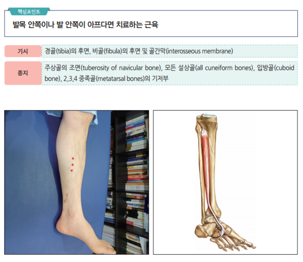 후경골근의 기시, 종지 정보와 함께 환자 다리에 표시된 치료점, 그리고 후경골근 해부학적 그림이 있는 이미지 — 서울 바로한의원 초음파 약침·도침