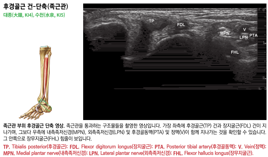 발목 족근관 부위의 해부학적 그림과 후경골근 건, 장지굴근 건, 내측족저신경, 외측족저신경, 후경골동맥, 정맥, 장무지굴근 힘줄이 보이는 초음파 영상 — 초음파 정밀 진단 | 서울 바로한의원 초음파 약침·도침·침도