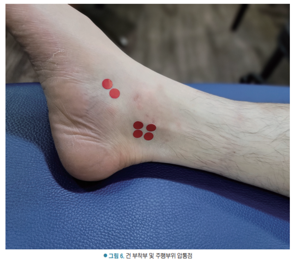 발목 안쪽에 빨간색 원형 스티커로 표시된 압통점들 — 서울 바로한의원 초음파 약침·도침