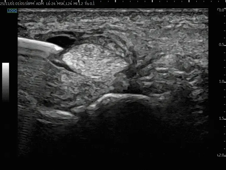 러닝 발목 안쪽 통증? 방치하면 평발이 되는 ‘후경골근 건염’의 정체 [초음파 약침]