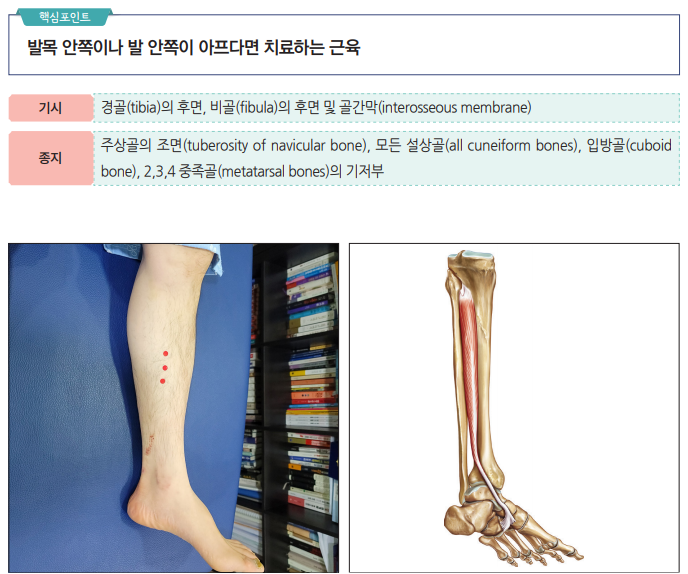 발목 안쪽 통증 치료를 위한 다리 혈자리와 후경골근 해부학적 그림 — 서울 바로한의원 초음파 약침·도침