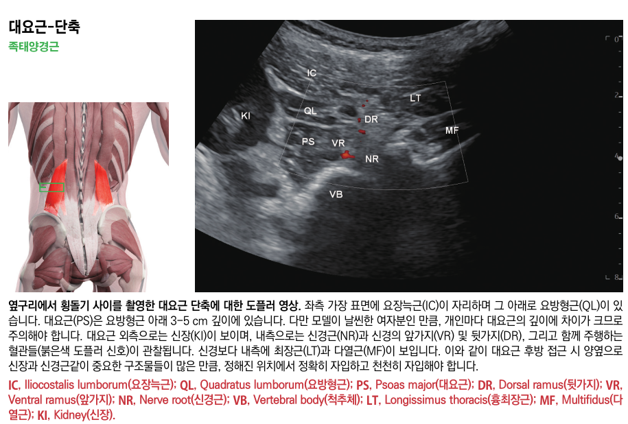 대요근의 해부학적 위치를 나타내는 인체 모형과 대요근, 신장, 신경근 등 주변 구조물과 혈류가 표시된 초음파 도플러 영상 — 초음파 정밀 진단 | 서울 바로한의원 초음파 약침·도침·침도