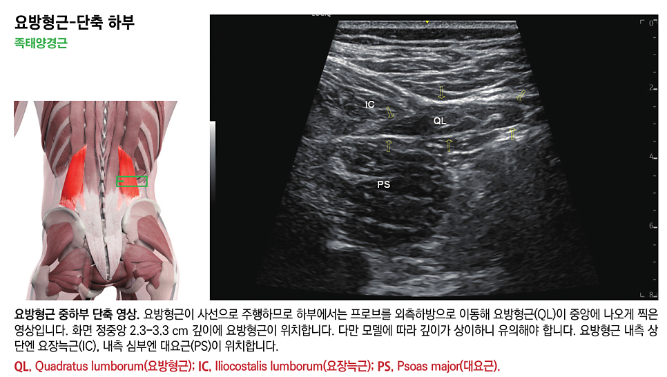 요방형근의 해부학적 그림과 요방형근, 요장늑근, 대요근이 표시된 초음파 영상 — 초음파 정밀 진단 | 서울 바로한의원 초음파 약침·도침·침도