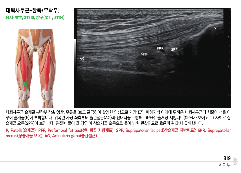 대퇴사두근의 슬개골 부착부 해부학적 그림과 무릎을 30도 굴곡하여 촬영한 초음파 영상. 초음파 영상에는 슬관절근, 전대퇴골 지방패드, 슬개상 지방패드, 상슬개골 오목이 표시되어 있다 — 초음파 정밀 진단 | 서울 바로한의원 초음파 약침·도침·침도