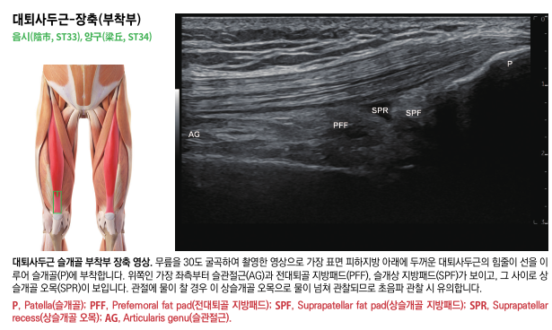 대퇴사두근 근육 해부도와 슬개골 부착부의 초음파 영상으로, 힘줄과 주변 지방패드가 보인다 — 초음파 정밀 진단 | 서울 바로한의원 초음파 약침·도침·침도