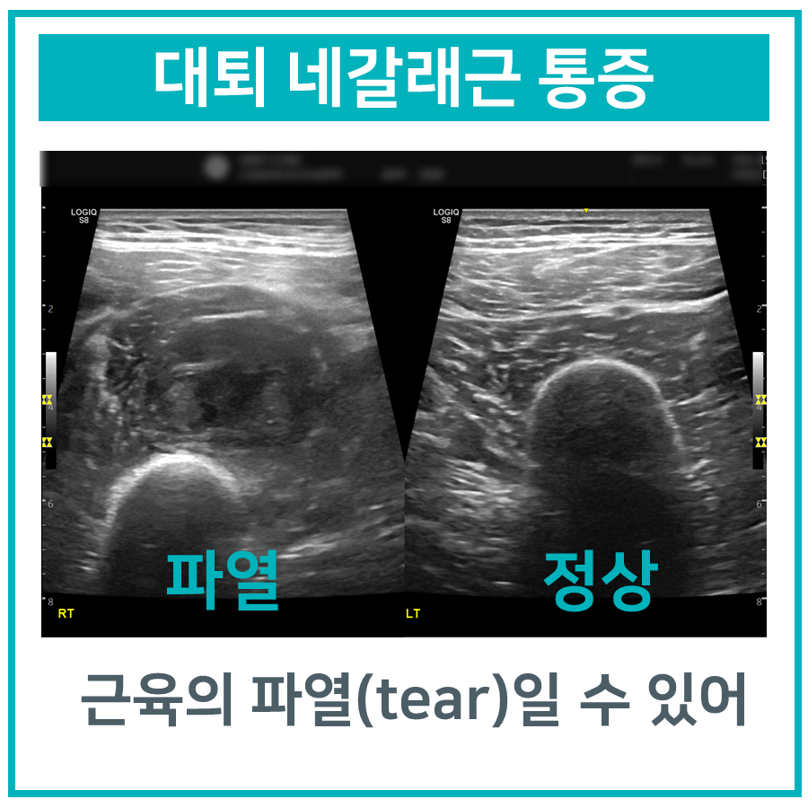 대퇴 네갈래근의 파열과 정상 상태를 비교한 초음파 사진 — 초음파 정밀 진단 | 서울 바로한의원 초음파 약침·도침·침도