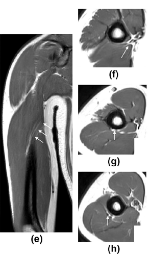 팔과 어깨 부위의 여러 MRI 영상으로, 요골신경으로 보이는 구조물에 화살표가 표시되어 있습니다 — 서울 바로한의원 초음파 약침·도침
